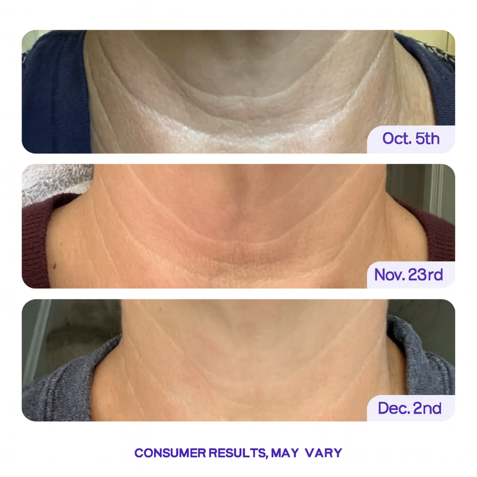 Key-Lift™ -  Tighten & Lift Neck Cream