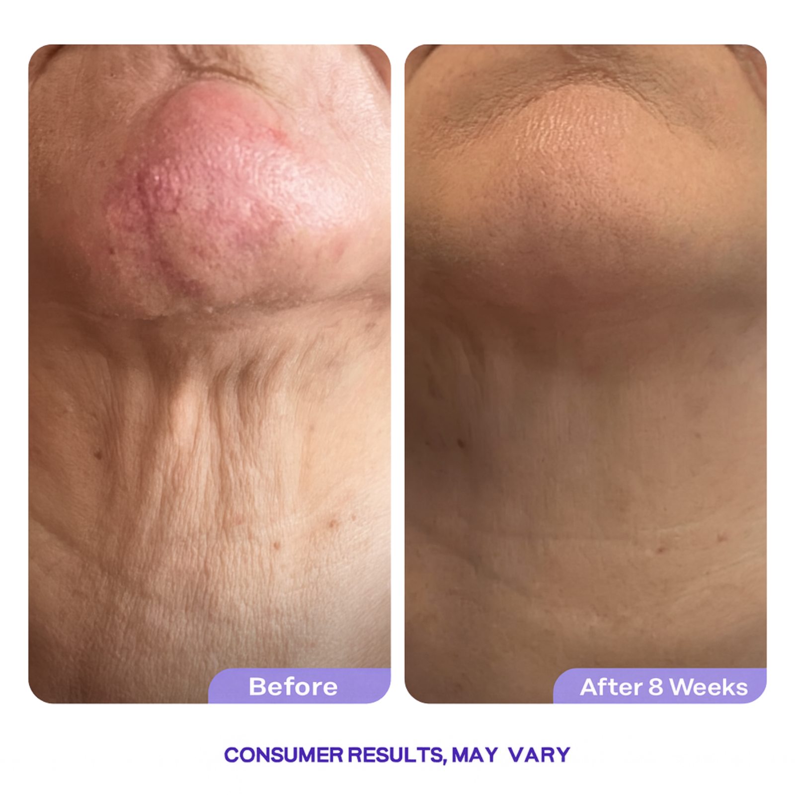 Key-Lift™ -  Tighten & Lift Neck Cream