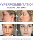 Klyne RX™ - Rapid Dark Spot Corrector