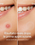 InvisiDots™ Pimples Patches – Seon