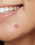 InvisiDots™ Pimples Patches – Seon