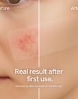  AreaFix™ AcneAway – Seon